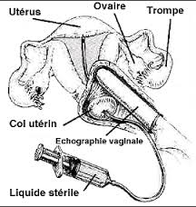 hystérosalpingographie